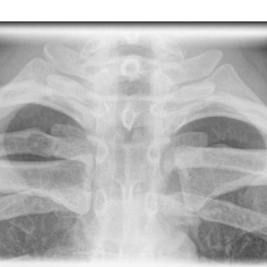 X-ray Right Sternoclavicular Joint LAT View